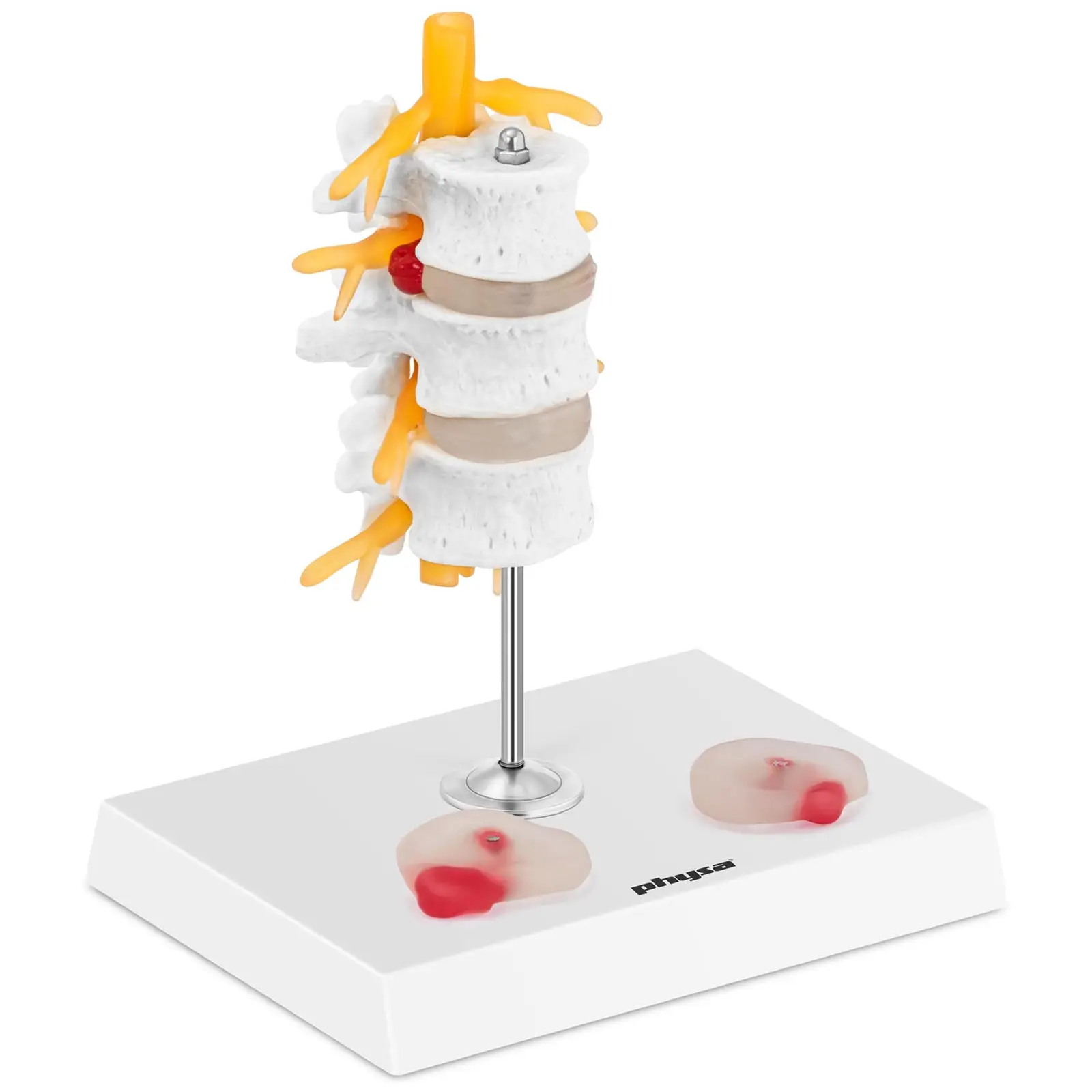 Modelo anatómico de discos intervertebrales - hernia discal - coloreado